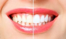 Teeth Whitening